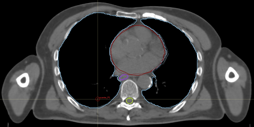 Figuur 2:Voorbeeld van de segmentatie van één CT-beeld. Blauw: longen, groen: luchtpijp, paars: slokdarm, geelgroen: ruggenmerg. Volle lijn: originele intekening, stippellijn: eigen gegenereerde intekening.