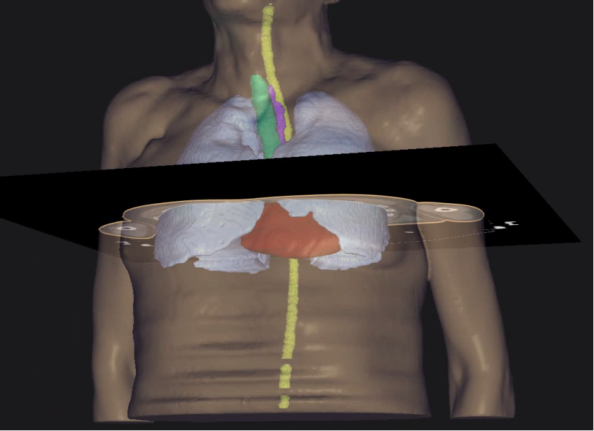 Figuur 3: 3D-beeld van een volledige eigen intekening. De aangeduide doorsnede is het CT-beeld van figuur 2. Rood: hart, lichtblauw: longen, groen: luchtpijp, paars: slokdarm, geelgroen: ruggenmerg.